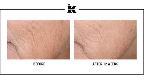 Before and After Retinol Serum