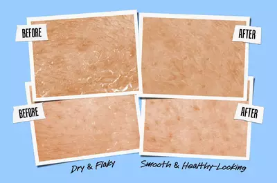 A comparison image showing two side-by-side pairs of "before" and "after" photos of skin. The "before" images depict dry and flaky skin, while the "after" images show smooth and healthy-looking skin.