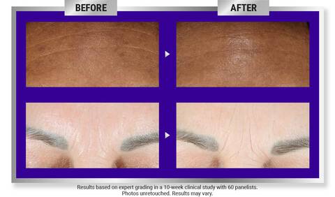 Before and After Retinol Serum