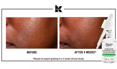 A side-by-side comparison showing skin texture before and after 4 weeks of using Kiehl’s Ultra Pure High-Potency Serum with 10% Niacinamide, demonstrating visible improvement in skin appearance.