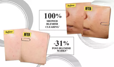 Before and after images demonstrating acne clearing results; the "before" image shows redness and blemishes, while the "after" image shows clearer skin with fewer visible blemish marks, highlighting a 100% success rate in acne clearing and a 31% reduction in post-blemish marks.