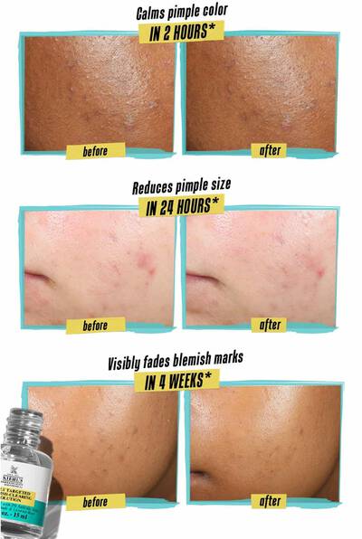 Alt text: A collage showing skin before and after using a product. The first image highlights reduced pimple color in 2 hours. The second shows a decrease in pimple size in 24 hours. The last pair of images illustrates visibly faded acne marks after 4 weeks. A product bottle is displayed at the bottom.