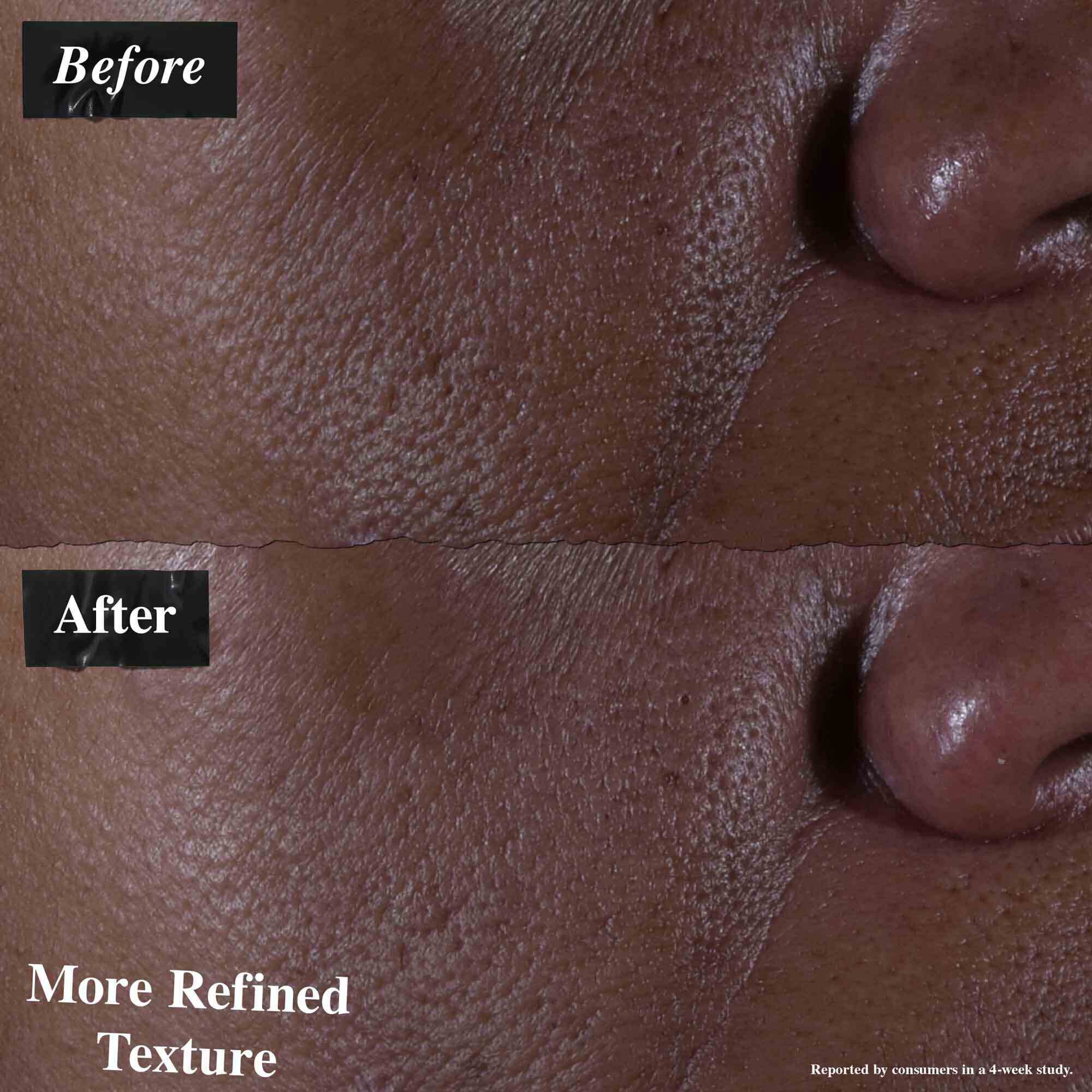 Une comparaison avant/apres montrant une peau traitee avec le serum Ultra Pure 9.8% Glycolic Acid. L'image « avant » montre une texture inegale, tandis que l'image « apres » montre une texture plus affinee.