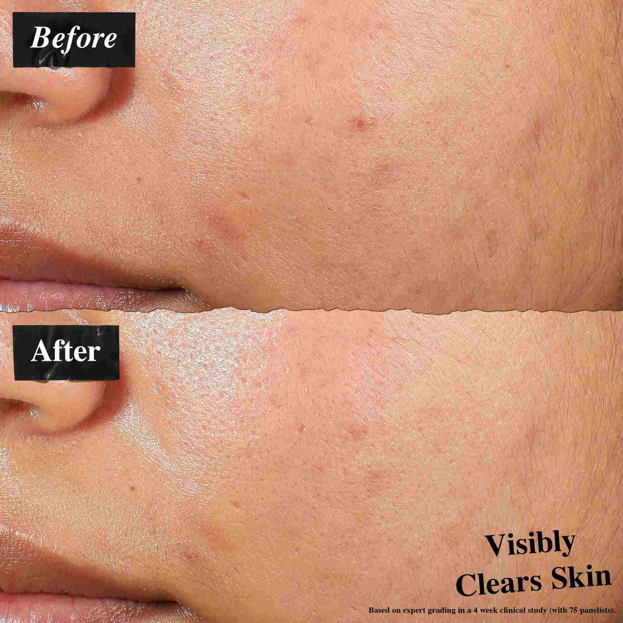 Une comparaison avant/apres montrant une peau traitee avec la lotion Expertly Clear Blemish-Treating & Preventing Lotion. L'image « avant » montre des imperfections et une texture inegale, tandis que l'image « apres » montre une peau visiblement plus nette.