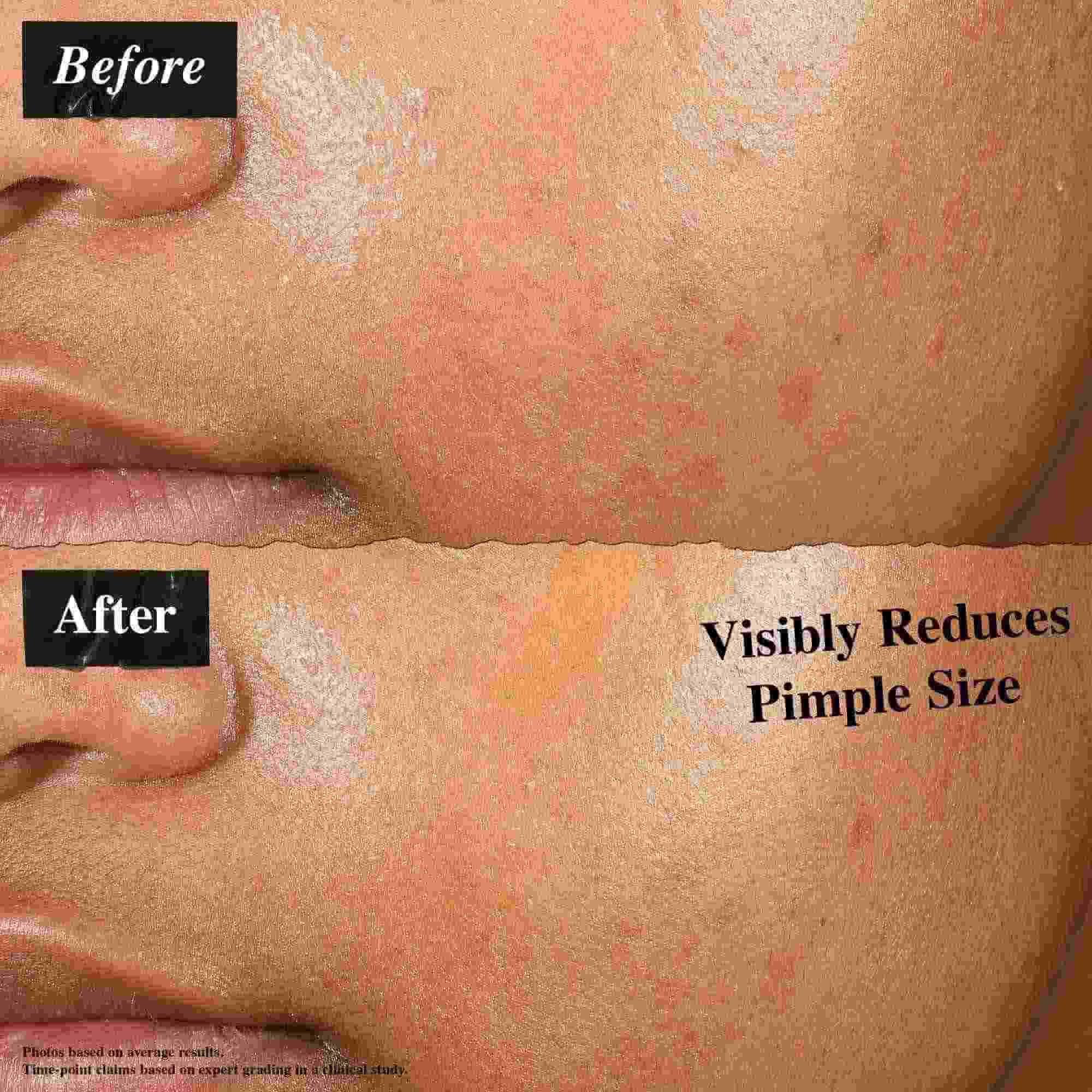 Une comparaison avant/apres montrant la peau traitee avec la solution Truly-Targeted Blemish-Clearing Solution. L'image « avant » montre des boutons visibles, tandis que l'image « apres » montre une taille de bouton reduite.