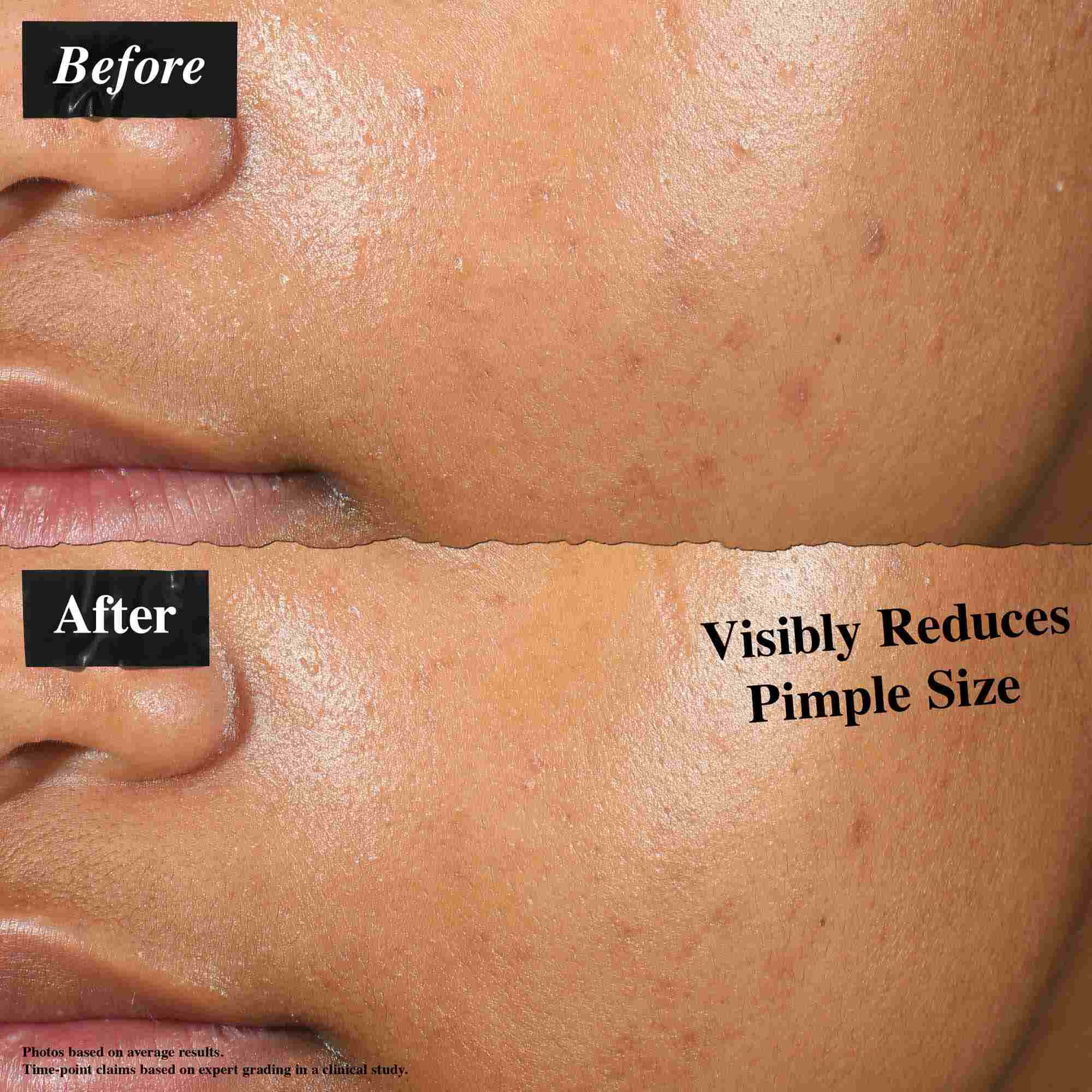 Une comparaison avant/apres montrant la peau traitee avec la solution Truly-Targeted Blemish-Clearing Solution. L'image « avant » montre des boutons visibles, tandis que l'image « apres » montre une taille de bouton reduite.